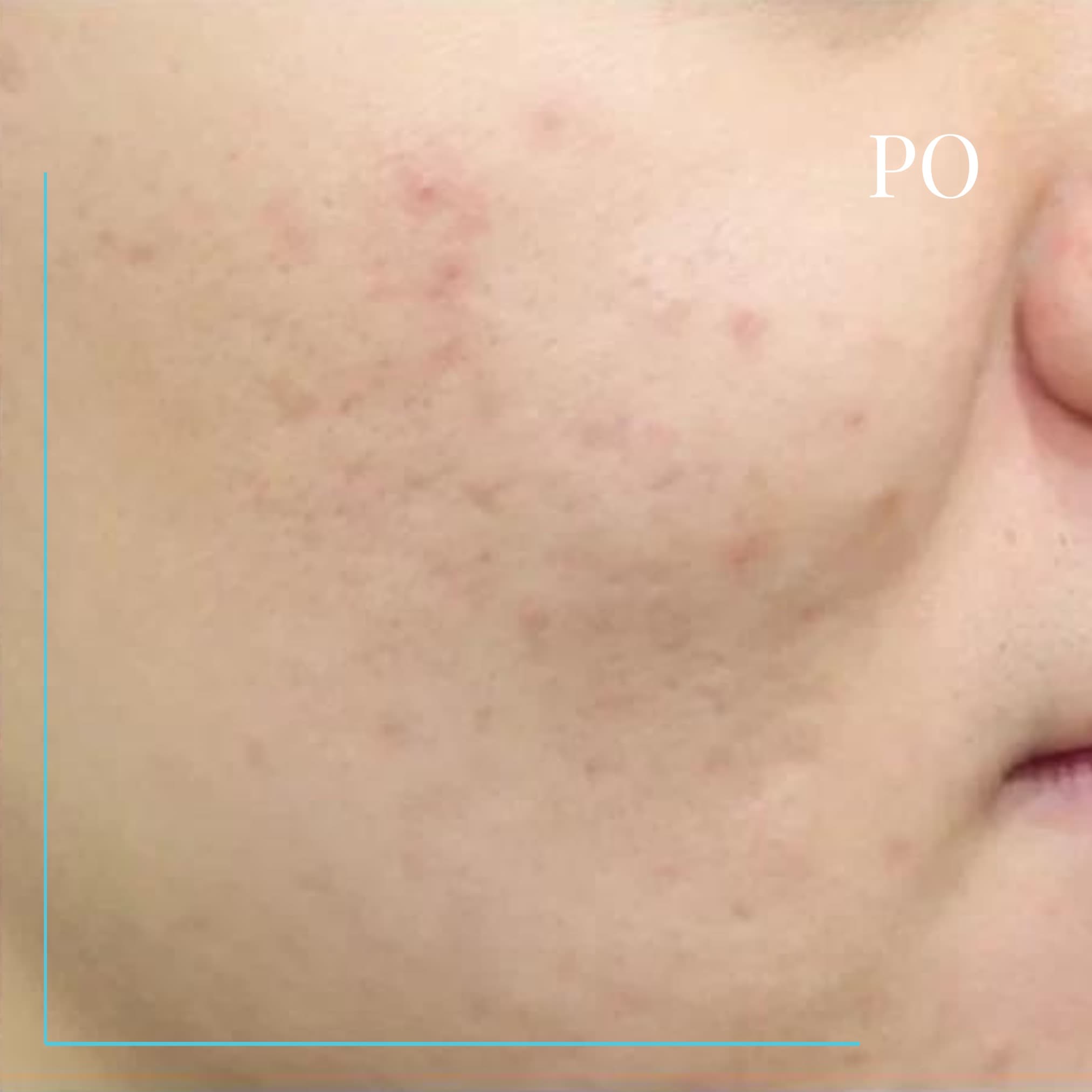 Aquapure - efekt po zabiegu