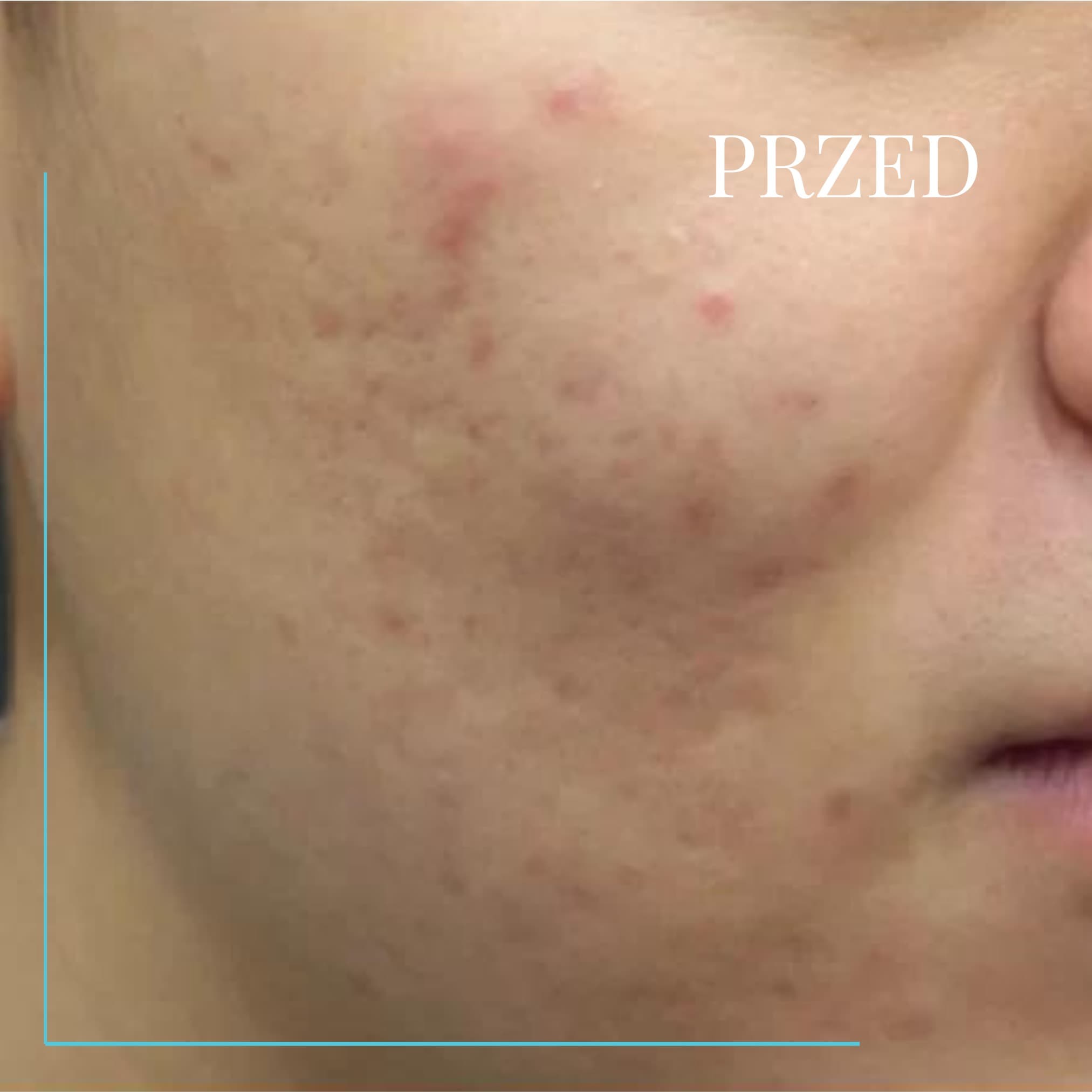 Aquapure - przed zabiegiem