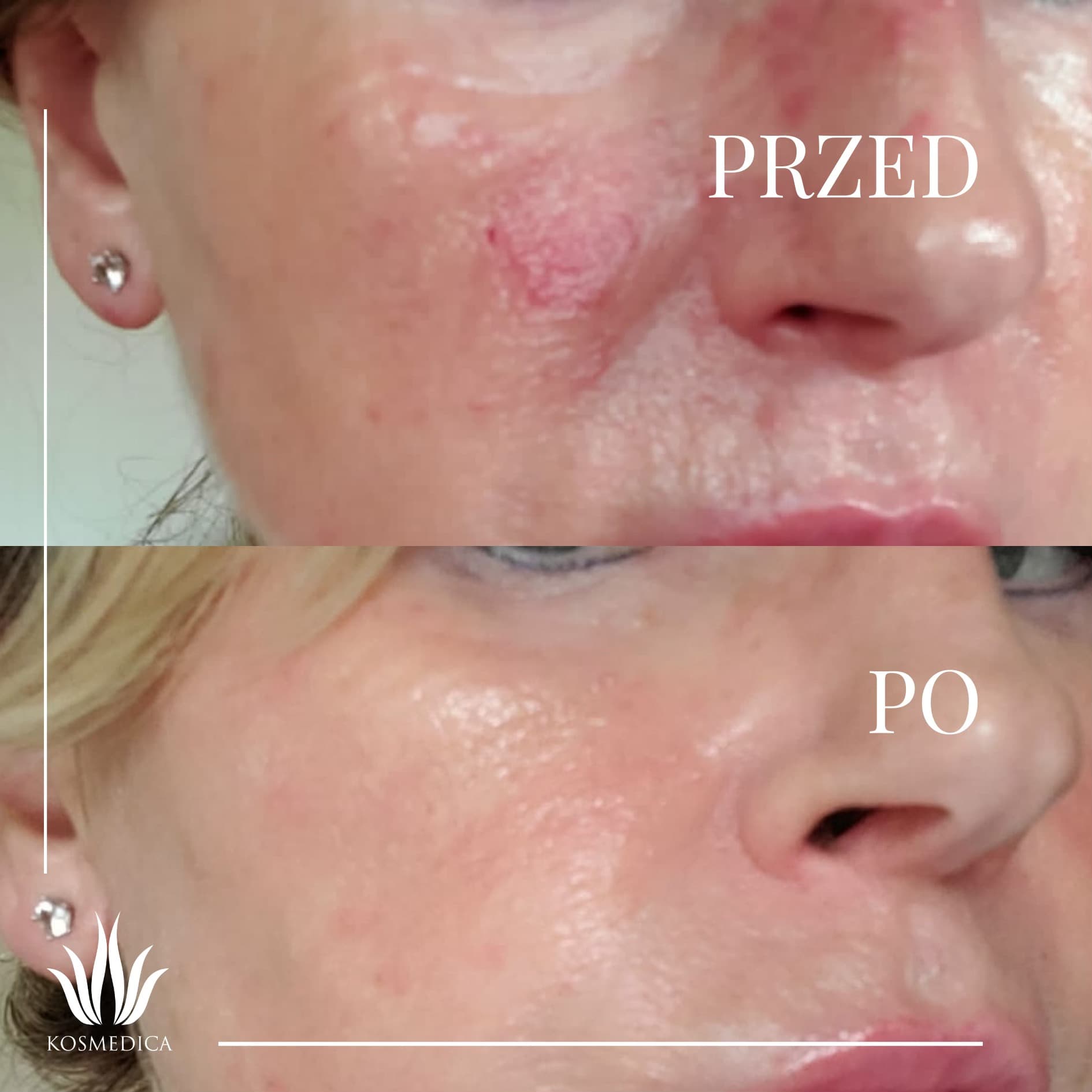 Laseroterapia - efekty