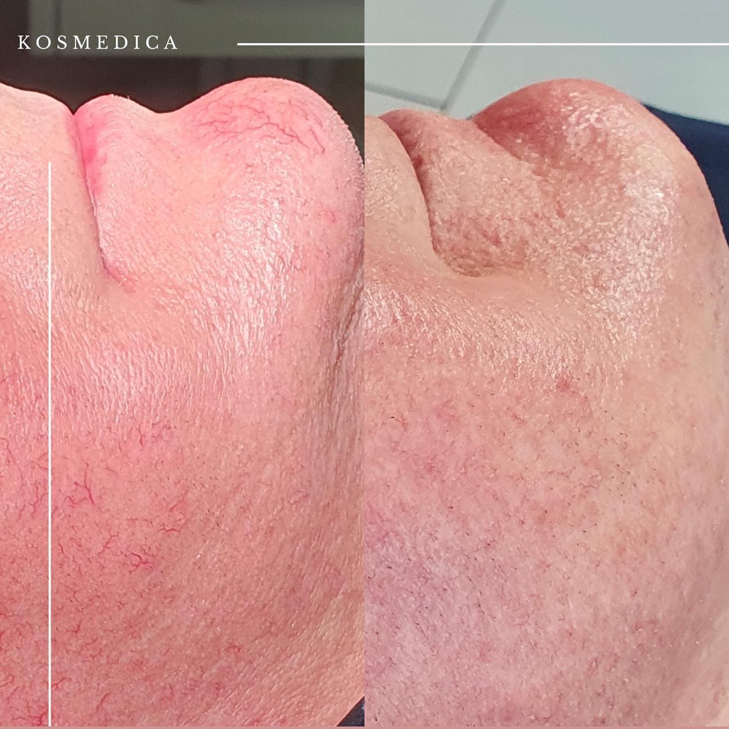 Zamykanie naczynek - efekty