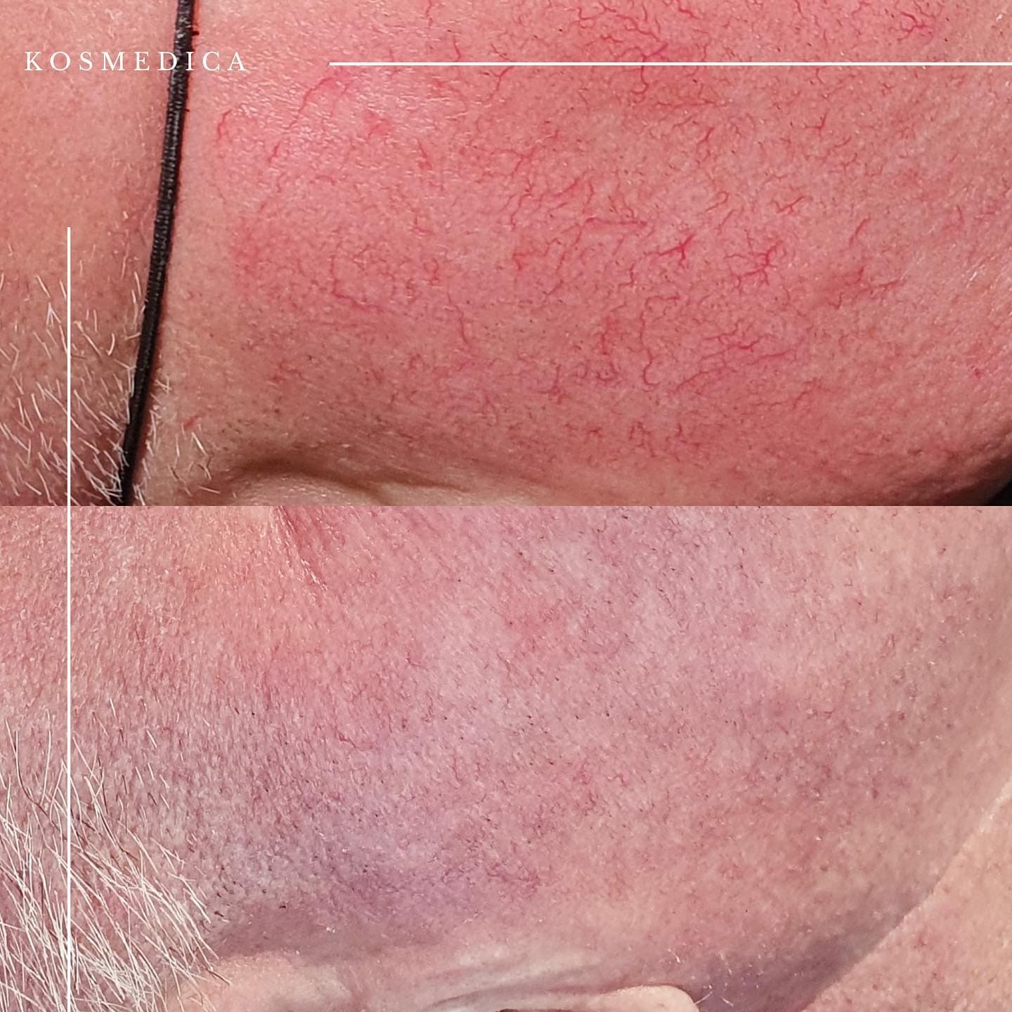 Zamykanie naczynek - efekty